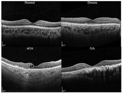 Two-step hierarchical neural network for classification of dry age-related macular degeneration using optical coherence tomography images